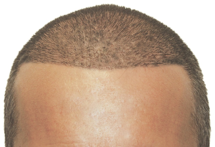 profollica regrow hair line